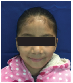 Figura 6. Imagen control tres aos despus, donde se aprecia armona en tejidos blandos y ausencia de asimetra facial.