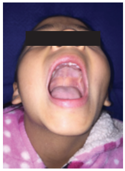 Figura 7. Apertura oral adecuada y datos clnicos de fibrosis por abordaje quirrgico.