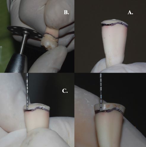 Preparacin de las longitudes coronarios. A. Corte de la corona anatmica. B. Longitud coronario de 0 mm a la unin cemento-esmalte. C. Longitud coronario de 1 mm a la unin cemento-esmalte. D. Longitud coronario de 2 mm a la unin cemento-esmalte.