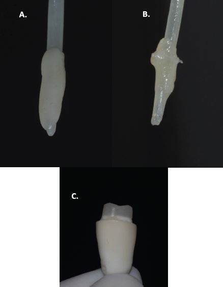 Poste de fibra de vidrio anatomizado. A. Colocacin de resina compuesta alrededor del poste. B. Impresin del conducto radicular con resina compuesta. C. Preparacin del mun coronario