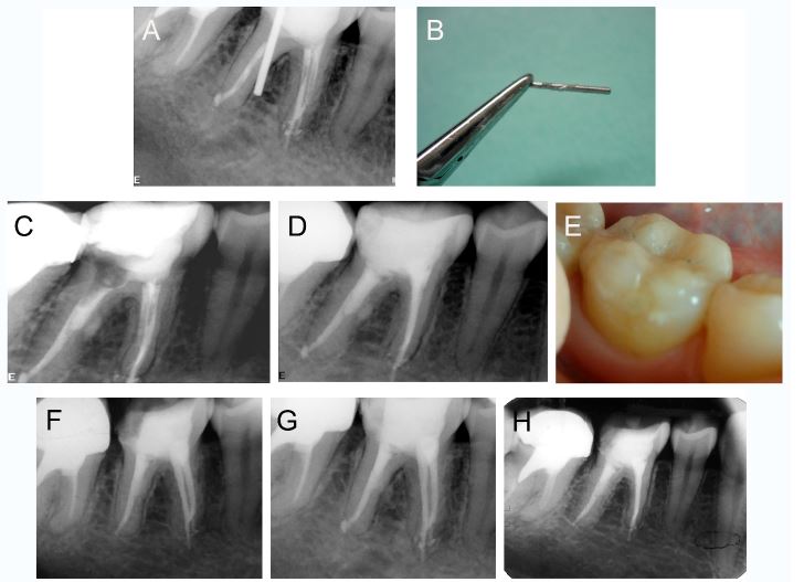 Illustrative images of the management of case 1, tooth 46. (A) Preoperative periapical radiograph. (B) Metal post removed from root canal. (C) Periapical radiograph after application of mineral trioxide aggregate into perforation site. (D) Postoperative periapical radiograph after final restoration. (E) Clinical view of the final restoration. (F) 3-month follow-up. (G) 1-year follow-up. (H) 3-year follow-up.