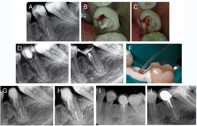 Illustrative images of the management of case 2, tooth 35. (A) Preoperative periapical radiograph. (B) Clinical view of the tooth crown with the fiber post exposed to the oral cavity. (C) Clinical view of tooth crown after fiber post removal. (D) Periapical radiograph after removal of fiber post and filling material. (E) Periapical radiograph showing the coronal tooth fracture and the application of mineral trioxide aggregate (MTA)into perforation site. (F) Clinical view of the application of MTA into perforation site. (G) Postoperative periapical radiograph, after placement of a fiber post (H) 6-month follow-up. (I) 2-year follow-up, after the placement of a metal post and crown for prosthetic reasons. (J) 6-year follow-up.