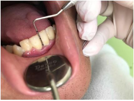 Sondaje de bolsas periodontales con sonda periodontal.