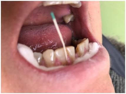 Colocacin del cono de papel para la toma de muestra de fluido crevicular