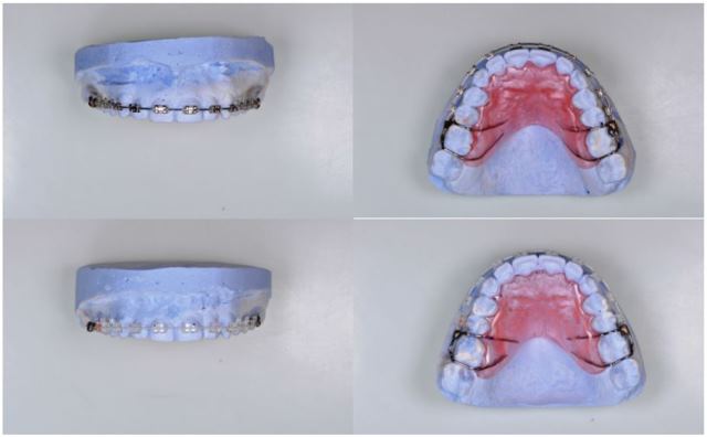 Custom removable appliances that allowed precise and reproducible placement different orthodontic appliance designs
