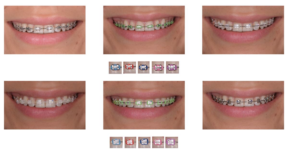 Different designs of othodontic appliances in the study identified with letters from A to F