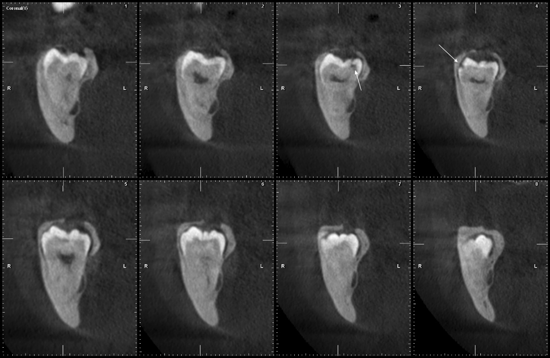THC (vxel 0,2) de la pieza 48, plano coronal. Se observan dos defectos hipodensos (flechas blancas). A la derecha, presencia de defecto de esmalte y dentina en cspide distolingual, profundidad menor a ⅓ del grosor dentinario (grado I); a la izquierda, presencia de defecto hipodenso de esmalte compatible con la fosa vestibular profunda