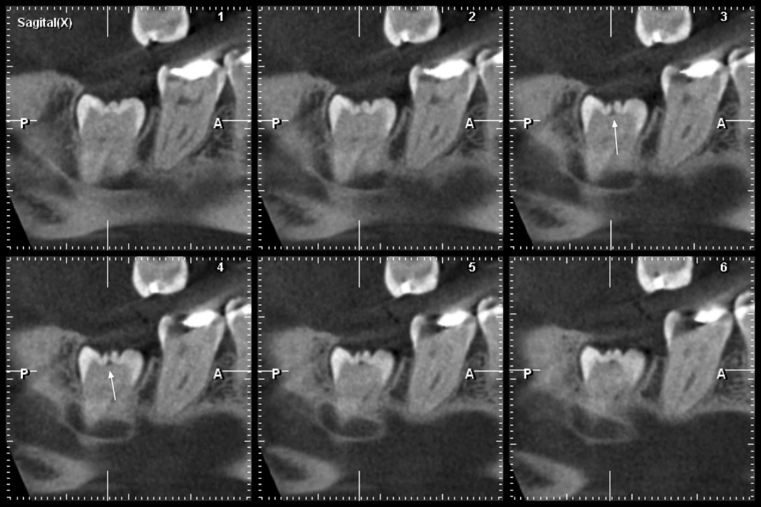 THC (vxel 0,2) de la pieza 48, plano sagital, cara lingual. Se observa el defecto hipodenso de RIPE en esmalte y dentina en la cspide distolingual, profundidad grado I