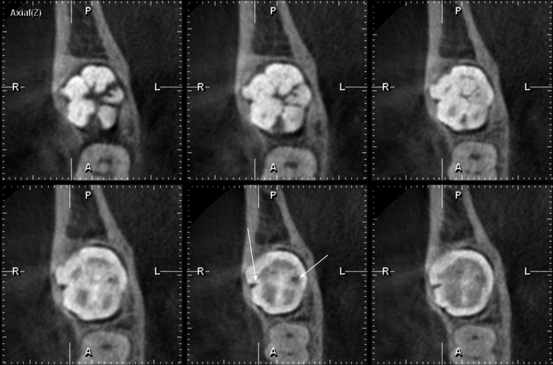 THC (vxel 0,2) de la pieza 48, plano axial. Flechas blancas, lado izquierdo: centro, fosa vestibular profunda; lado derecho: centro, presencia de defecto hipodenso de RIPE en cspide distolingual