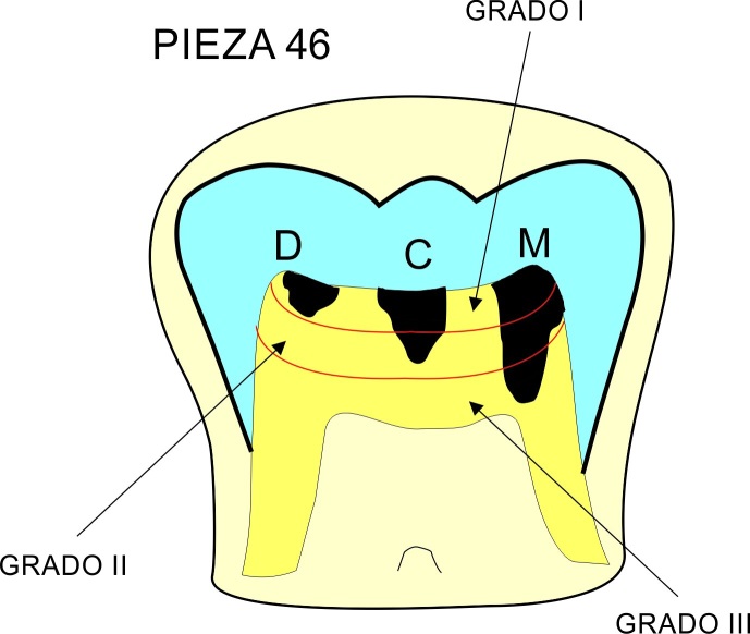 Representacin grfica de la pieza 46.  Descripcin de la posicin anteroposterior y de los grados de profundidad de la RIPE. De izquierda a derecha :distal (D), centro (C) y mesial (M); y grados I, II y III, respectivamente.