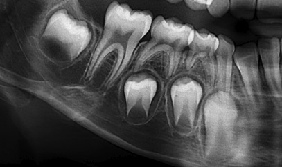 Lesin radiolcida (pieza 44) subyacente a la unin amelodentinaria en distal; la profundidad es menor a ⅓ del ancho dentinario (grado I).