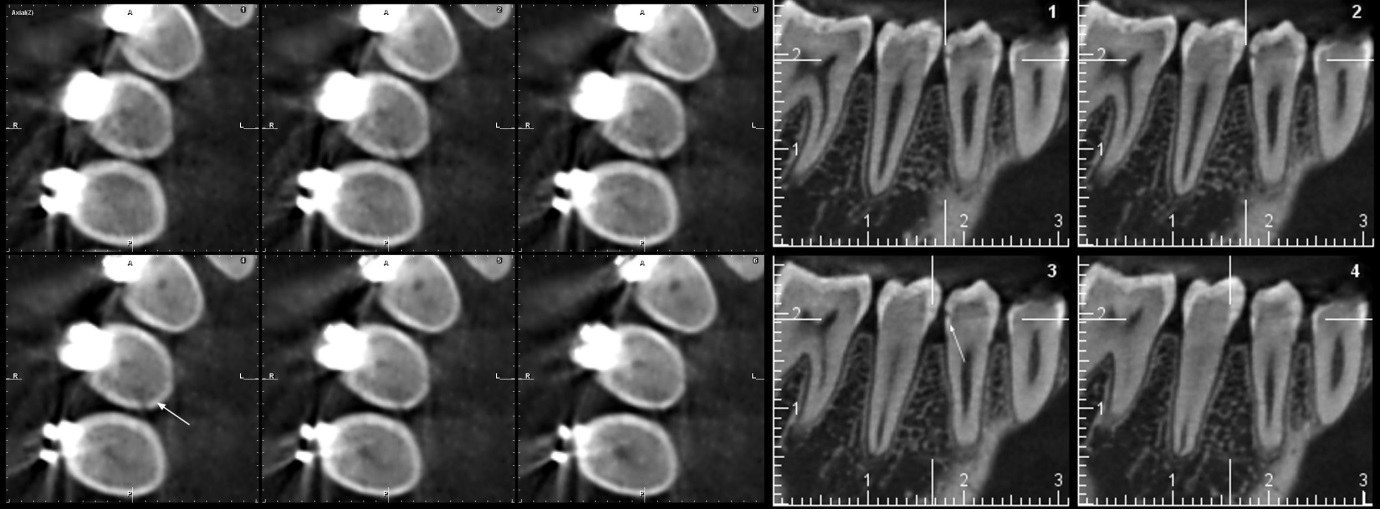THC (vxel 0,15) de la pieza 44, lado izquierdo, plano axial (superior) y sagital (inferior). Se observa (flechas blancas) defecto hipodenso en esmalte y dentina; el compromiso dentinario es menor a ⅓ (grado I).