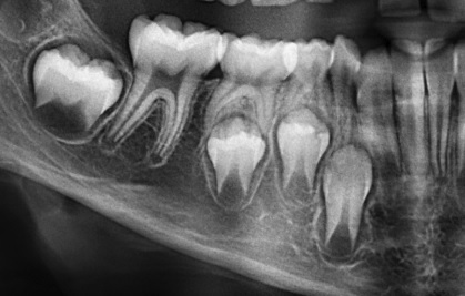 Lesin radiolcida de esmalte y dentina (pieza 44) ubicada en oclusomesial