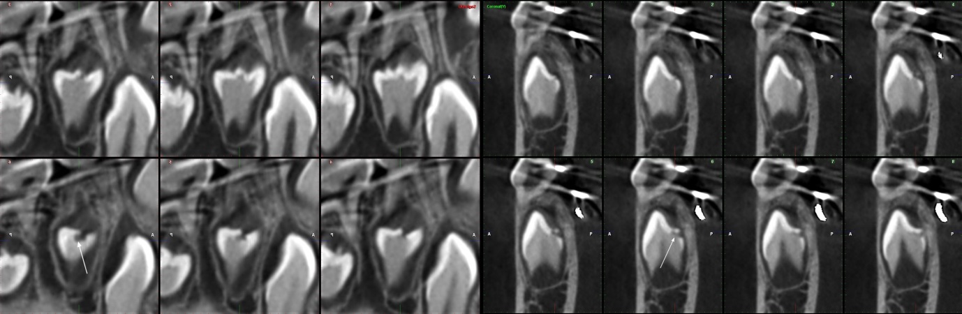 THC (vxel 0,15) de la pieza 44, plano sagital (superior) y plano coronal (inferior). Se aprecia defecto hipodenso de esmalte y dentina (flechas blancas) en cresta mesial de la cspide lingual; la profundidad del defecto es menor a ⅓ del ancho dentinario (grado I).