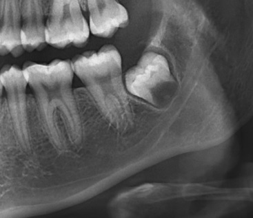 Lesin radiolcida de forma triangular de base inferior (pieza 38) en relacin con la cspide distal