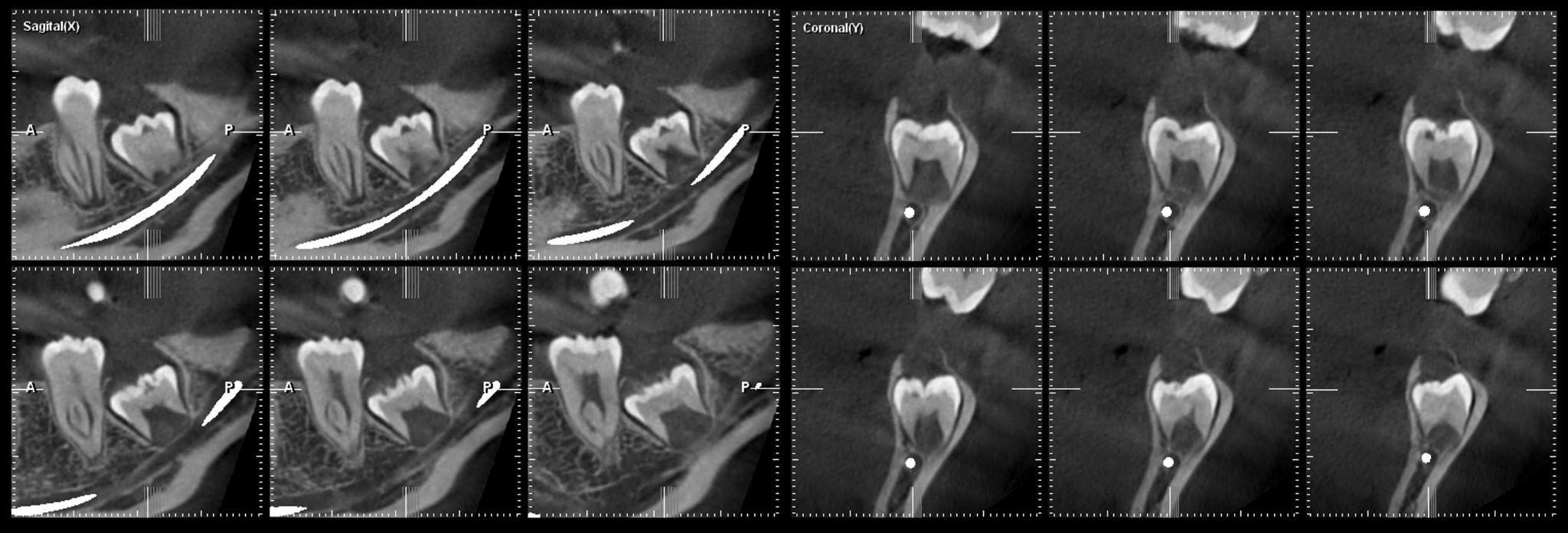THC (vxel 0,2) de la pieza 38, plano sagital (izquierdo) y plano coronal (derecho). Se aprecia el defecto hipodenso en la cspide distolingual. En el plano sagital se observa la discontinuidad del esmalte de la cspide distolingual