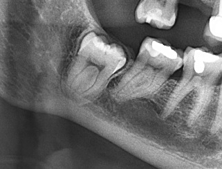 Lesin radiolcida (pieza 48) en la cara mesial. Presencia de imagen radiolcida central compatible con la fosa profunda vestibular.