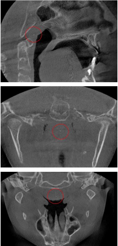 Tonsilolito en amgdala nasofarngea