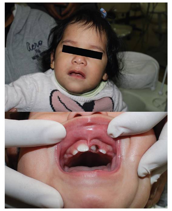 Evaluaci�n extraoral: se observa edema de la zona izquierda del labio inferior. Evaluaci�n intraoral: se observa desplazamiento apical de la pieza 61.