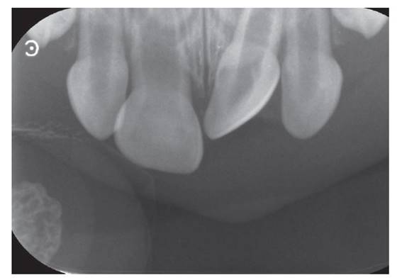Radiograf�a periapical: pieza 61 giroversada con desplazamiento apical.