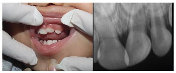 Control a los 2 meses despu�s del traumatismo. Cl�nicamente, se observa reerupci�n parcial de la pieza 61. Radiogr�ficamente, se muestra �pice abierto de la pieza dental comprometida.