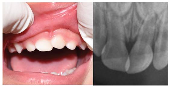 Control a los 5 meses posteriores al traumatismo. Cl�nicamente se observa tejidos duros y blandos con caracter�sticas normales.