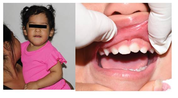 Control a los 7 meses despu�s del traumatismo. Cl�nicamente, se observa tejidos duros y blandos sanos alrededor de la pieza 61. Radiogr�ficamente, se muestra formaci�n completa de la ra�z de la pieza traumatizada.