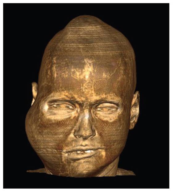 Reconstrucci�n volum�trica con vista de tejidos blandos que muestra la asimetr�a facial por aumento de volumen en la regi�n facial derecha. No se expone fotograf�a por decisi�n de la paciente en el consentimiento.