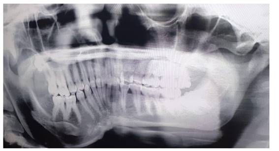 Radiograf�a panor�mica que muestra radiopacidad mixta en cuerpo y rama mandibular izquierda con presencia de zonas l�ticas, escler�ticas y patr�n de vidrio esmerilado en la regi�n dentada. �rea radiopaca con aspecto de odontoma en regi�n de 18 y ausencia de 48.