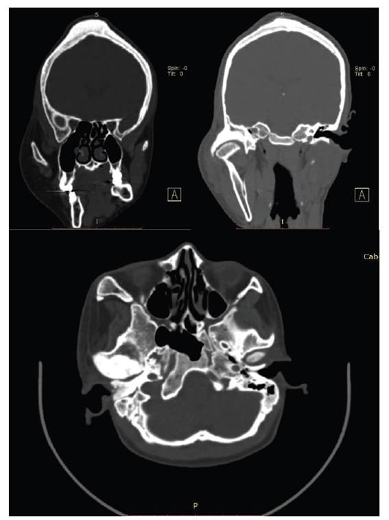 Reconstrucciones axial y coronal donde se muestran las lesiones �seas y la preservaci�n de los senos maxilar y etmoidal y la cavidad orbitaria.