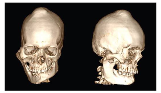 Reconstrucci�n volum�trica (frontal y lateral). Se observa crecimiento expansivo que afecta al lado mandibular derecho y al hueso cigom�tico, as� como una protuberancia en el polo superior del cr�neo.