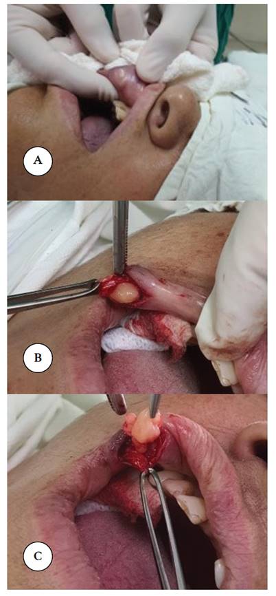 Aspecto cl�nico y quir�rgico de la lesi�n. A: Aspecto de la lesi�n antes de la cirug�a. B y C: Imagen de la biopsia excisional de la lesi�n.