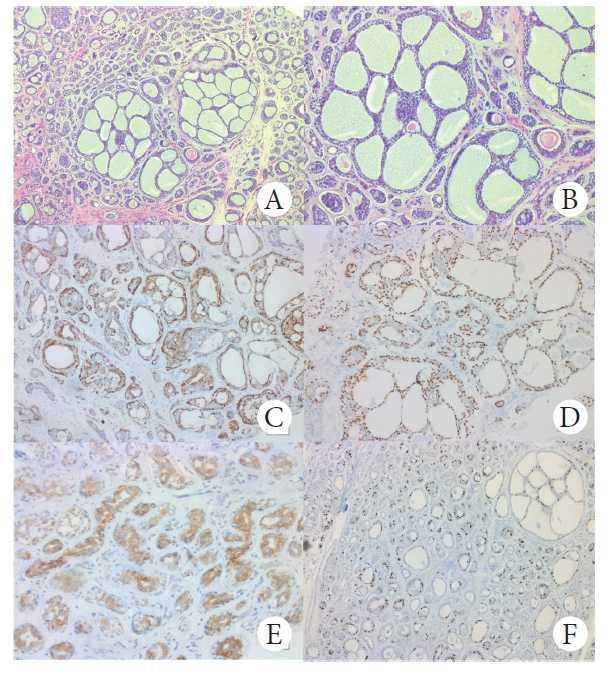 Caracter�sticas histopatol�gicas de la neoplasia. A: Proliferaci�n de c�lulas tumorales en un patr�n cribiforme y tubular. B: Islotes cribiformes formados por c�lulas de escaso citoplasma y n�cleo hipercrom�tico con microquistes de contenido mucinoso. C: C�lulas mioepiteliales positivas citoplasm�ticas para SMA. D: C�lulas mioepiteliales positivas nucleares para p63. E: C�lulas internas positivas citoplasm�ticas para CD117. F: Ki-67 con �ndice del 10 %.