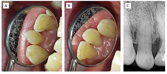Pieza 2.2 (A) con dens invaginatus en forma de surco palatino y su contralateral, pieza 1.2 (B), la cual presenta anatom�a normal (presentaci�n unilateral). Radiograf�a periapical (C) de la pieza 2.2, en la que observamos dens invaginatus tipo I seg�n Oehlers.