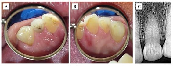 Pieza 2.2 (A) con dens invaginatus en forma de fosa palatina y su contralateral, pieza 1.2 (B), la cual presenta anatom�a normal (presentaci�n unilateral). Radiograf�a periapical (C) de la pieza 2.2, en la que observamos dos invaginaciones y dens invaginatus tipo II seg�n Oehlers.