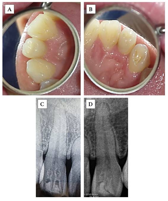 Piezas 1.2 (A) y 2.2 (B) con dens invaginatus en forma de barril (presentaci�n bilateral). Radiograf�as periapicales de las piezas 1.2 (C) y 2.2 (D), en las que observamos, respectivamente, dos invaginaciones y dens invaginatus tipo I seg�n Oehlers.