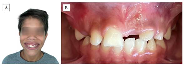 Fotos iniciales del paciente. A) Sonrisa de frente; B) Oclusal de frente.