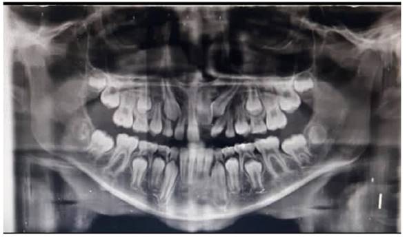 Radiograf�a panor�mica inicial.