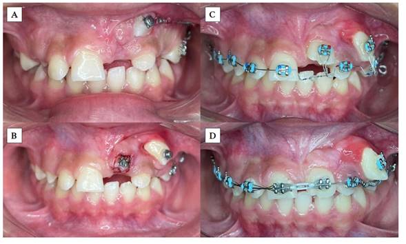 Evoluci�n de tracci�n de canino superior izquierdo con ayuda de minitornillo. A) Distalizaci�n de UD 23 con resorte cerrado de nitinol al anclaje absoluto (minitornillo); B) Distalizaci�n de UD 23 completada, hojal y cementado de bracket en UD 21; C) Mec�nica ortod�ncica de alineaci�n y nivelaci�n con tracci�n a distancia de UD 21 y 23; D) Fase de trabajo para manejo de espacios y ubicaci�n de la UD 23 en el arco dentario.