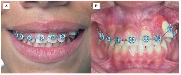 A) Fase de alineaci�n y nivelaci�n ortod�ncica; B) Consolidaci�n de espacios, alineaci�n y nivelaci�n de la UD 23.
