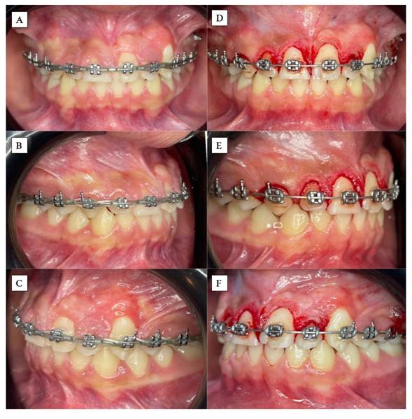 A) Fotograf�a de frente en m�xima intercuspidaci�n previo tratamiento periodontal; B) Fotograf�a de lado derecho en m�xima intercuspidaci�n previo tratamiento periodontal; C) Fotograf�a de lado izquierdo en m�xima intercuspidaci�n previo tratamiento periodontal; D) Fotograf�a de frente en m�xima intercuspidaci�n despu�s de la realizaci�n de la gingivectom�a y gingivoplastia sector anterosuperior, conservando adecuada cantidad de enc�a queratinizada; E) Fotograf�a lateral derecha en m�xima intercupidaci�n despu�s de la realizaci�n de la gingivectom�a y gingivoplastia solo tocando la UD 13, conservando una adecuada cantidad de enc�a queratinizada; F) Fotograf�a lateral izquierda en m�xima intercupidaci�n, donde no se realiza ning�n procedimiento periodontal por el defecto presente en el contorno de la UD 23.