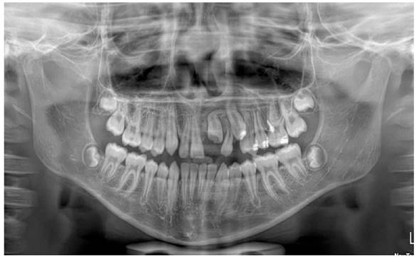 Radiograf�a panor�mica de control para observar la ubicaci�n de las UD 22 y 23, sin presencia de reabsorciones radiculares.