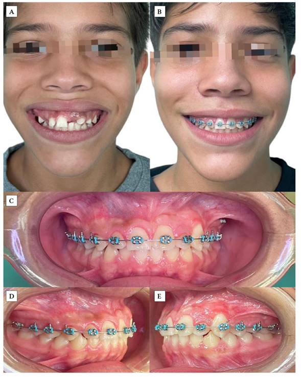 A) Fotografia facial de frente previo a tratamiento; B) Fotograf�a facial de frente posterior a tratamiento; C) Fotograf�a intrabucal de frente en m�xima intercuspidaci�n posterior a completar el tratamiento; D) Fotograf�a intrabucal de lado derecho en m�xima intercuspidaci�n posterior al tratamiento; E) Fotograf�a intrabucal de lado izquierdo en m�xima intercuspidaci�n posterior al tratamiento.