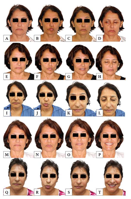 Clinical evolution of Bell&rsquo;s palsy treated with low-level light therapy. First session: facial asymmetry at rest (A), labial protrusion (B), eyebrow elevation (C), and partial occlusion of the right eyelid (D). Third session: partial improvement of right lip paralysis due to labial protrusion (F), improvement in eyebrow elevation (G), and complete eyelid occlusion (H). Fourth session: significant improvement in facial asymmetry at rest (I), lip protrusion (J), and eyebrow asymmetry (simultaneous elevation) (K). Sixth session: more symmetrical profile and improvement in the disproportionate lip protrusion (N). Seventh session (last): significant improvement in all facial expressions, greater symmetry at rest (Q), and improvement in lip protrusion (R), eyebrow elevation (S), and smile (T).
