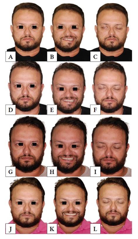 Clinical evolution of Bell&rsquo;s palsy treated with low-level light therapy. First session: facial asymmetry at rest, as seen by the depression of the labial commissure on the right side when compared to the left (A), labial and right eyelid immobility when smiling (B), and incomplete occlusion of the right eyelid (C). Seventh session: partial improvement at rest (D) and complete occlusion of the right eyelid (F). Nineteenth session: improvement in labial and eyelid asymmetry on the right side when smiling (H), as compared with the left side and previous sessions. Twenty-fourth session (last): significant improvement in all facial expressions at rest (J), smiling (K), and occlusion of the eyelid (L).