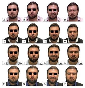 Clinical evolution of Bell&rsquo;s palsy treated with low-level light therapy. First session: facial asymmetry at rest (A), labial protrusion (B), smiling (C), and difficult occlusion of the right eyelid (D). Fourth session: slight improvement of right lip paralysis due to labial protrusion (F), slight improvement in smiling (G), and complete eyelid occlusion (H). Sixth session: significant improvement in facial asymmetry at rest (I), lip protrusion (J), smiling (K), and complete eyelid occlusion (L). Eighth session (last): Complete improvement in all facial expressions like symmetry at rest (M), in lip protrusion (N), smile (O), and eyelid occlusion (P).