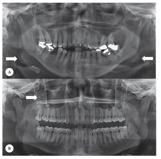 Panoramic radiography image with arrows suggesting the presence of (A) calcification of the stylohyoid ligament, and (B) anthrolith.