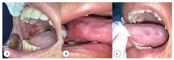 Fotograf�a intraoral: A) �lceras en la mucosa yugal derecha; B) �lceras en proceso de cicatrizaci�n en la cara lateral derecha de la lengua; C) placas blancas cicatriciales en la cara lateral izquierda de la lengua.