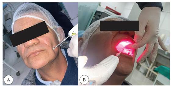 Aplicaci�n del l�ser de baja potencia: A) zona extraoral con aplicaci�n de luz infrarroja; B) zona intraoral con aplicaci�n de luz roja.