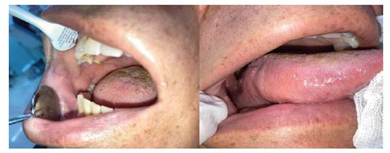 Remisi�n de las lesiones ulceradas en mucosa yugal y del borde lateral derecho de la lengua.